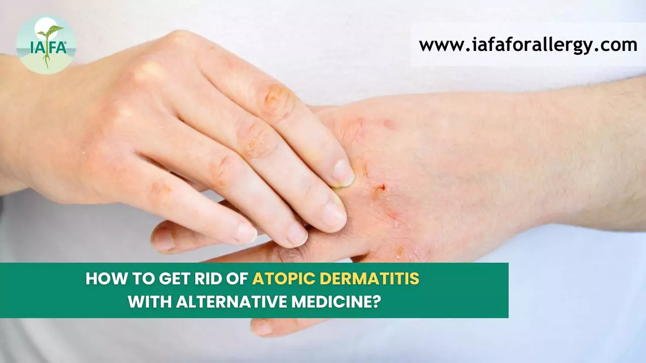 how to get rid of atopic dermatitis