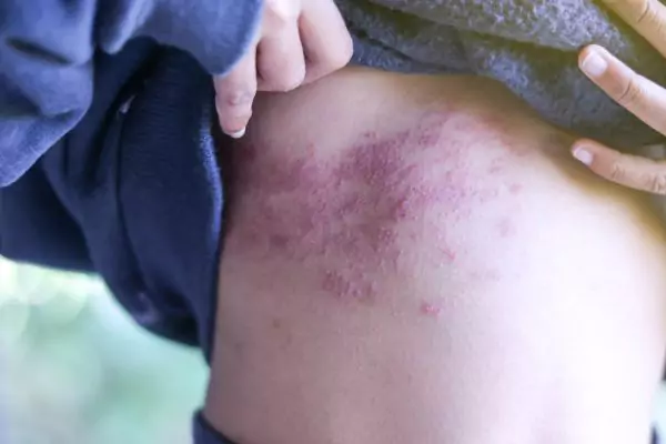 Urticaria - Causes, Symptoms and Ayurvedic Treatment