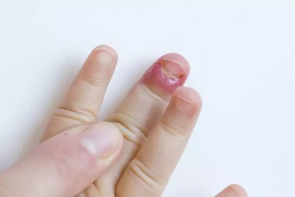 Manage Nail Infection in Children