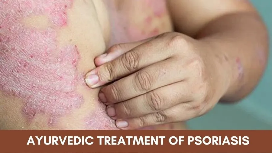 Ayurvedic Treatment for Psoriasis - Causes, Symptoms and More