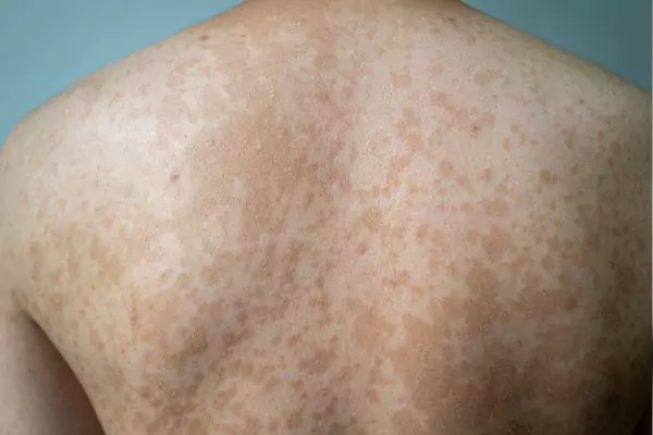tinea versicolor Treatment