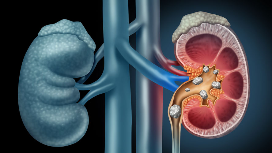 Kidney Stones and it’s Ayurvedic Management