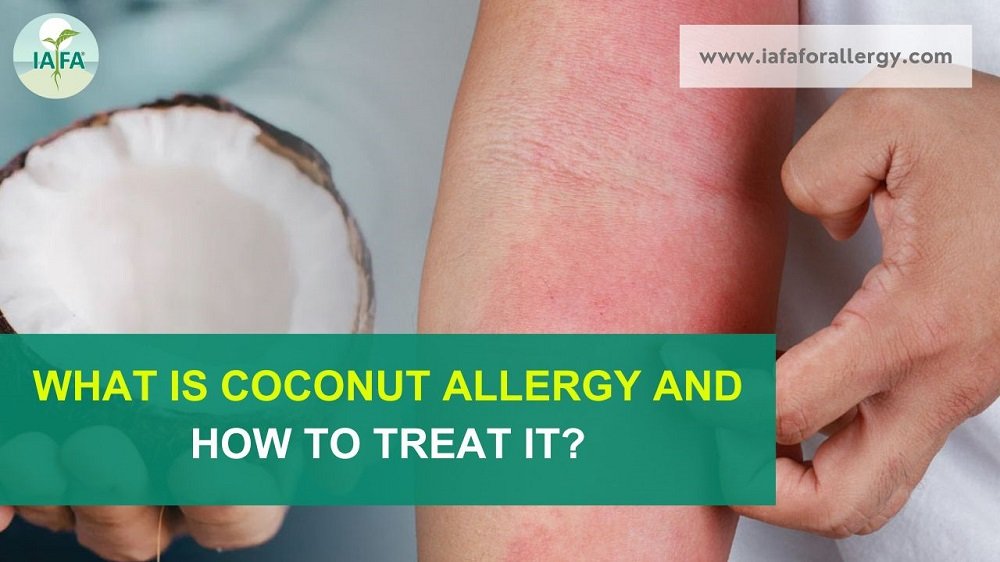 What is Coconut Allergy and How to Treat It?