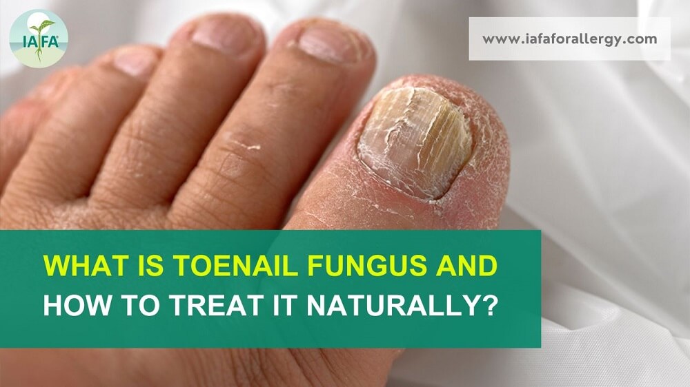 Toenail Fungus – Natural Treatment, Causes, Symptoms and More