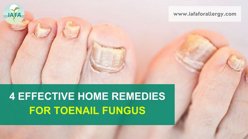 4 Effective Home Remedies for Toenail Fungus