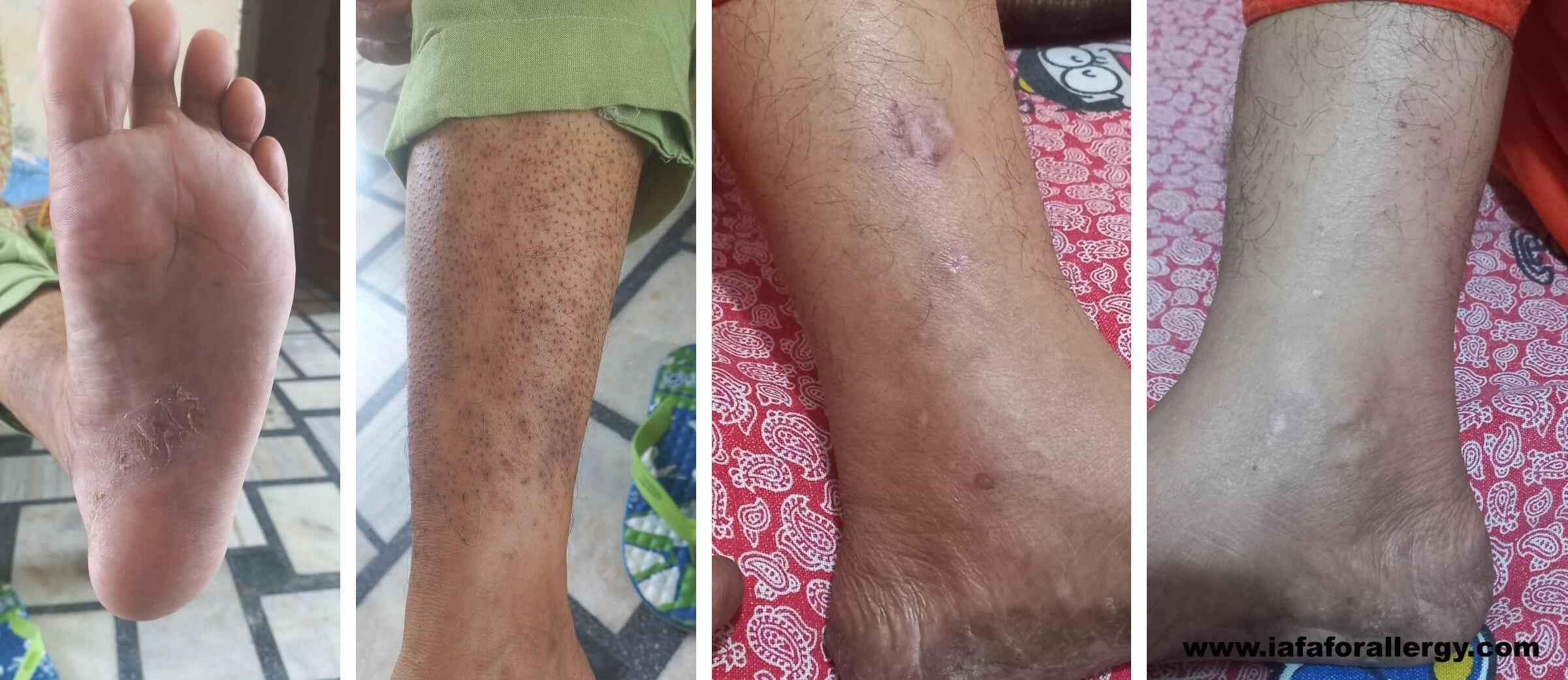 40-Year-Old Female Patient Recovered from Dyshidrotic Eczema and Onychomycosis - A Case Study