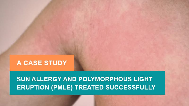12-Year-Old Child Recovered from Sun Allergy and Polymorphous Light Eruption (PMLE) – A Case Study