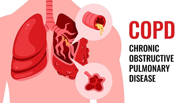 Chronic Obstructive Pulmonary Disease (COPD) Ayurvedic Treatment - Types, Causes, Symptoms and More