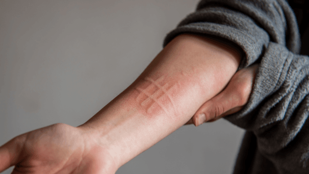 Dermatographia Ayurvedic Treatment - Causes, Symptoms and More