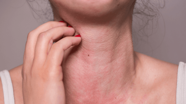 Mast Cell Diseases