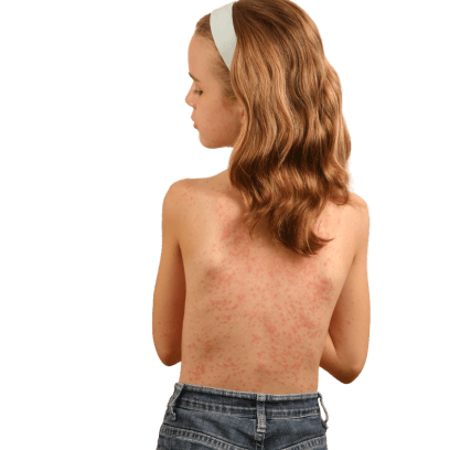 Ayurvedic Treatment for Mast Cell Diseases - Types, Causes, Symptoms and More