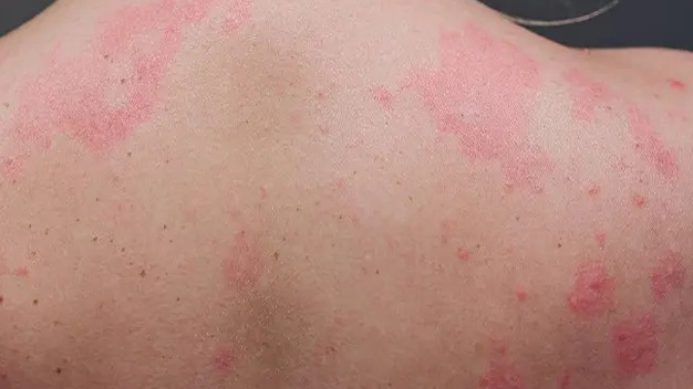 Mast Cell Diseases