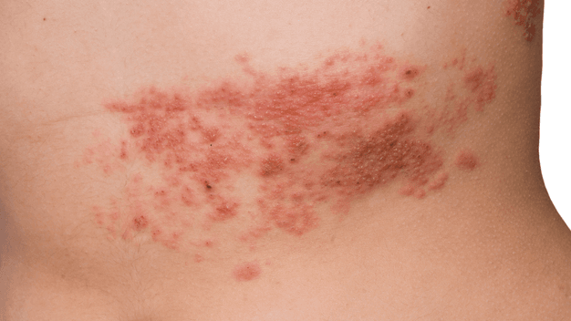 Herpes Zoster (Shingles)