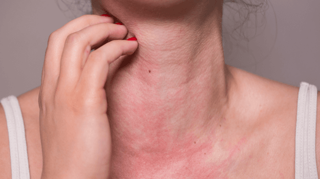 Polymorphous Light Eruption (PMLE)
