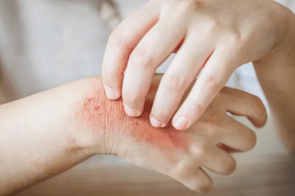 Fungal Infection Fungal Infection