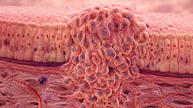 Carcinoma
