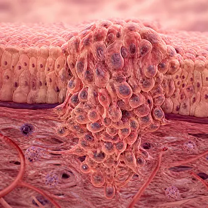 Carcinoma: Types, Symptoms & Ayurvedic Treatment Guide