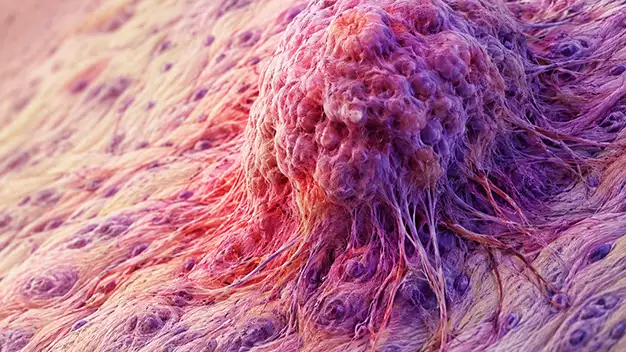 Sarcoma: Types, Symptoms & Ayurvedic Treatment Guide