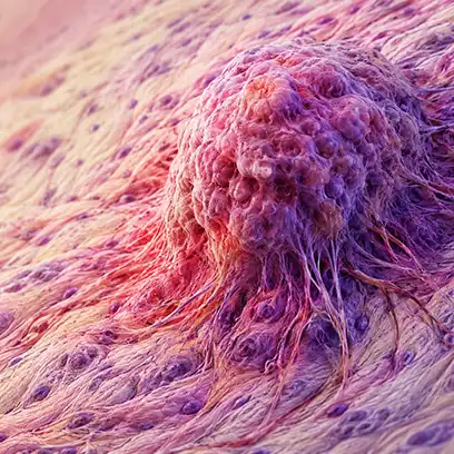 Sarcoma: Types, Symptoms & Ayurvedic Treatment Guide