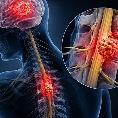 Spinal Cord and Brain Cancer: Types, Symptoms & Ayurvedic Treatment Guide