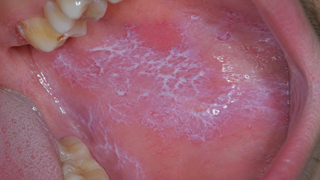 Oral Lichen Planus