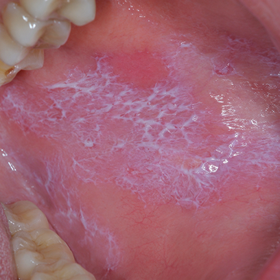 Oral Lichen Planus: Symptoms, Causes & Ayurvedic Treatment