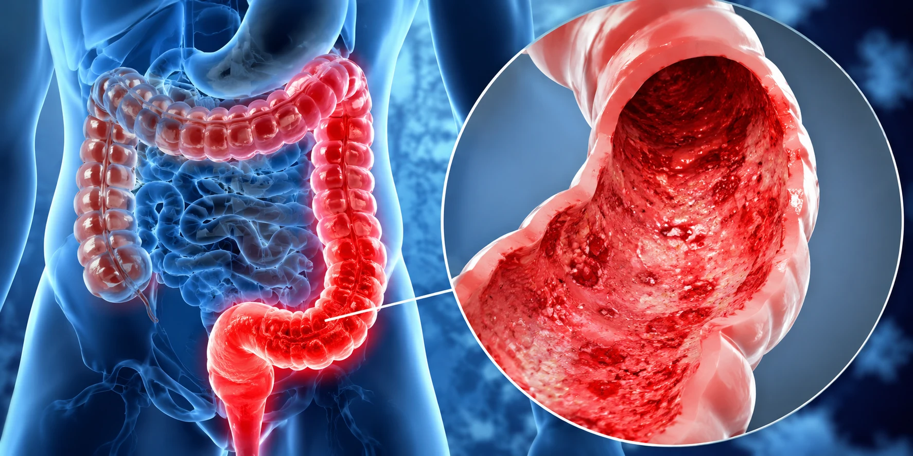 Ulcerative Colitis (UC)