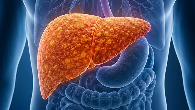 Ayurvedic Treatment for MASLD | Fatty Liver Care