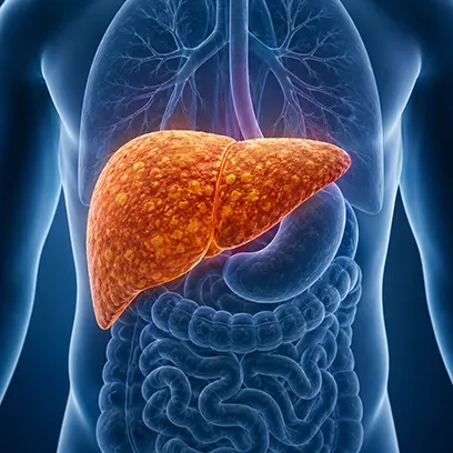 Ayurvedic Treatment for MASLD | Fatty Liver Care